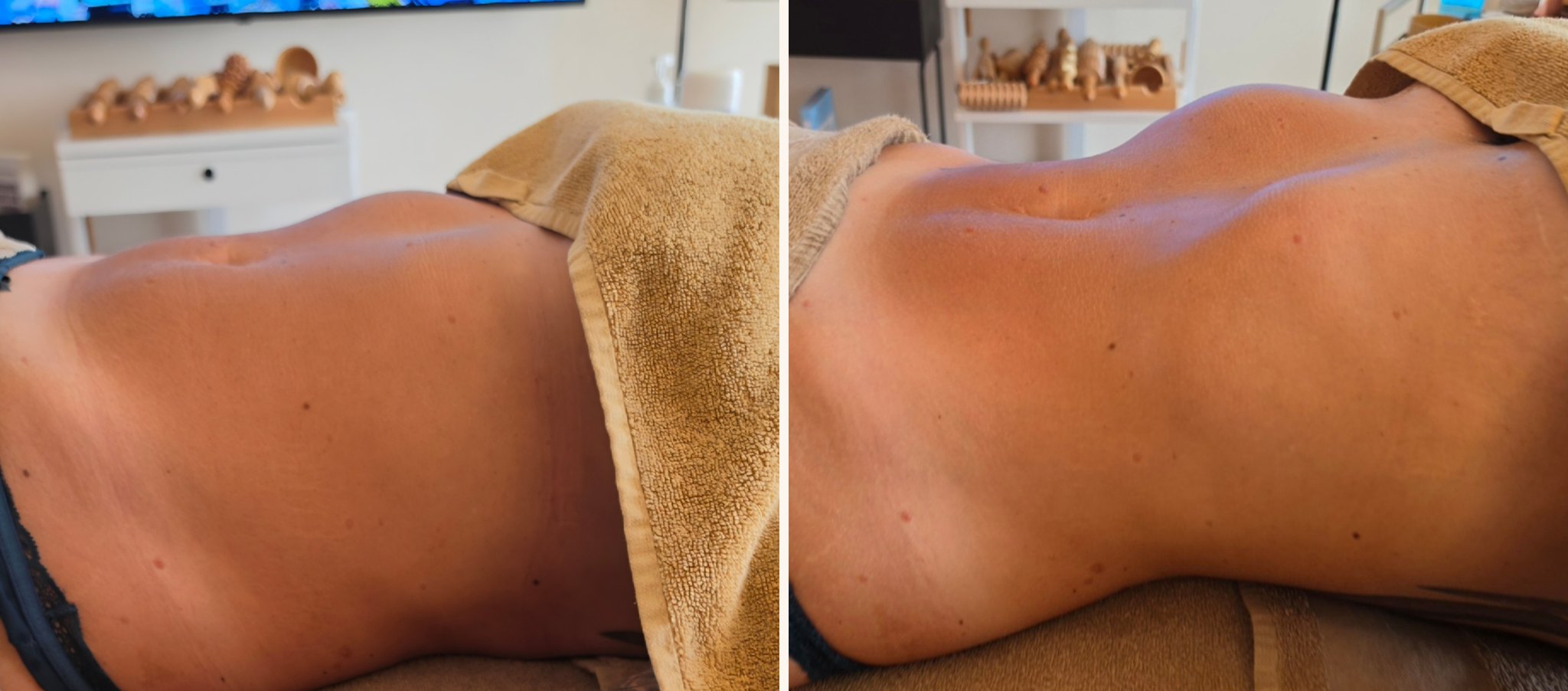 Bauch und Taille einer Kundin vorher und nachher